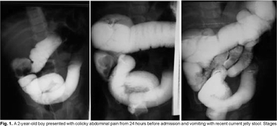 Reducing Childhood Intussusception {faces}